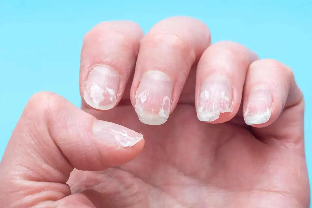 Kırılan Tırnak Kurtarma Yöntemleri (Acil Çözümler)