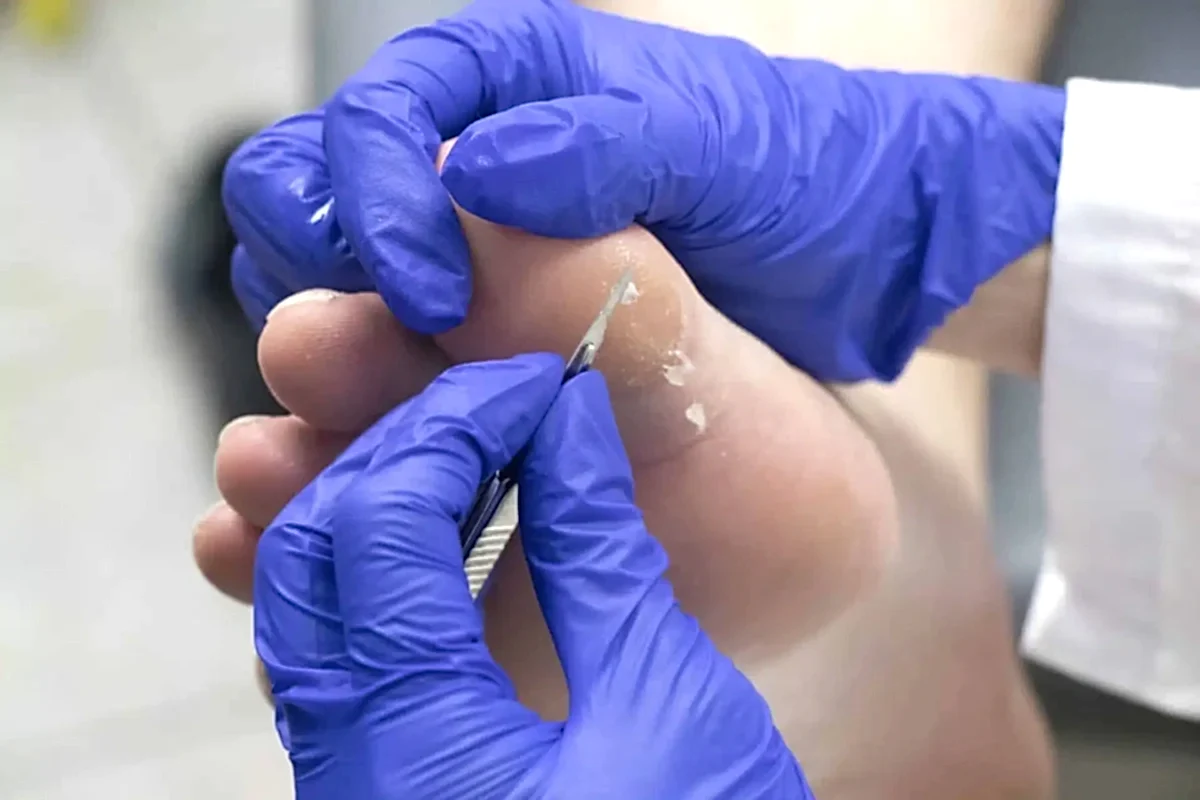 Ümraniye Nasır Temizleme: Ağrısız Adımlara Giden Profesyonel Yol