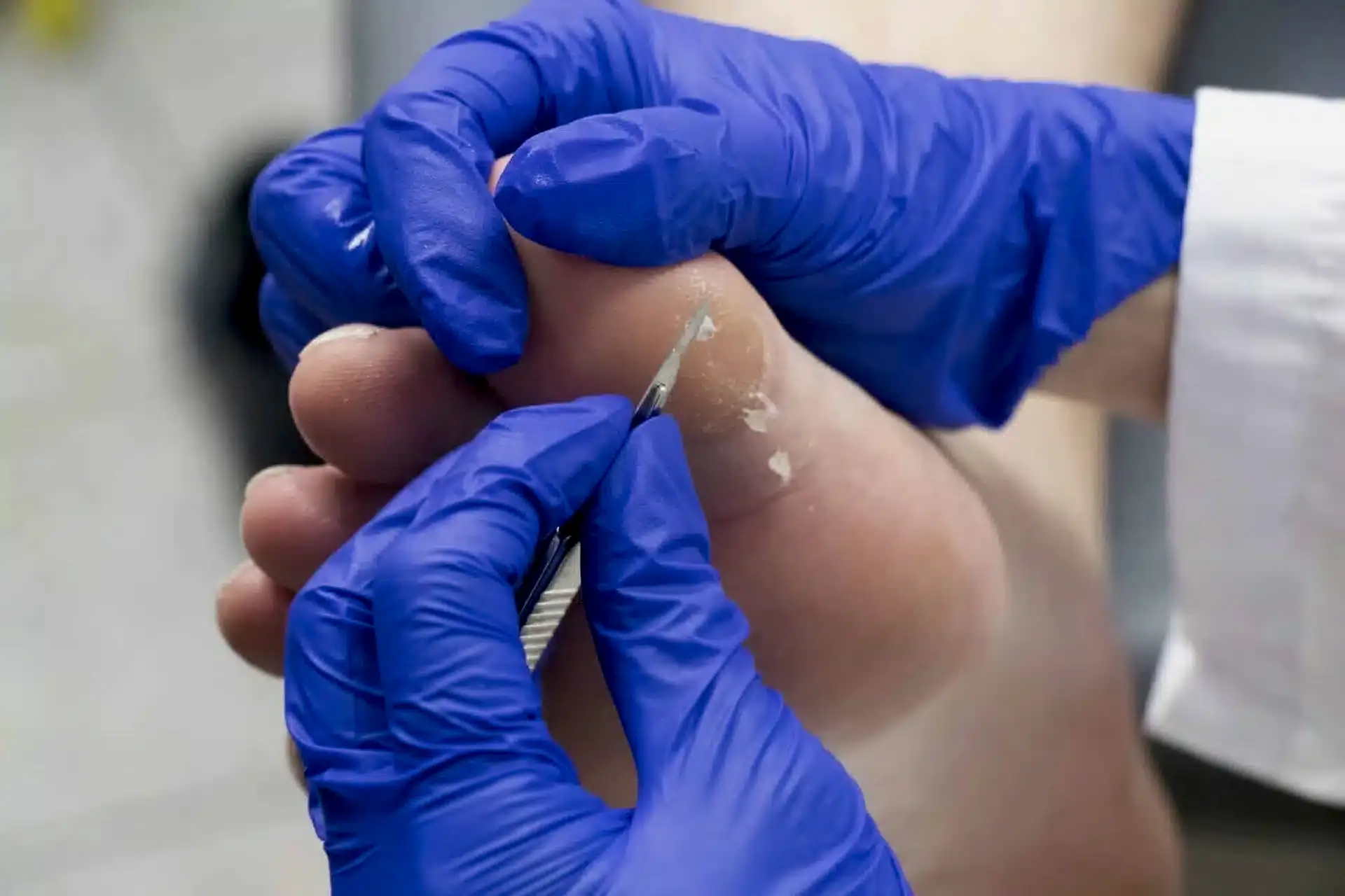 Ümraniye Nasır Temizleme: Ağrısız Adımlara Giden Profesyonel Yol